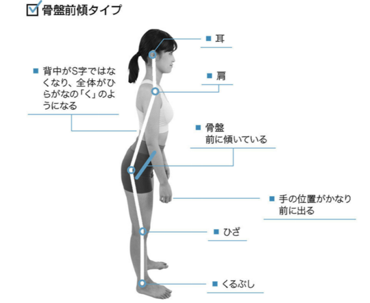 治す 方法 骨盤 前 傾 骨盤後傾の原因は？矯正のストレッチや治すための筋トレは？